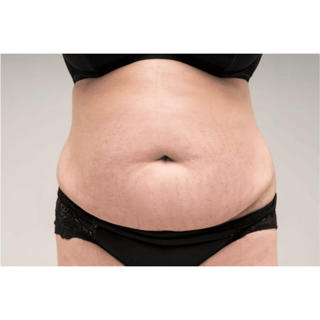 body-contouring-clinic-in-kochi-stretch-mark-after