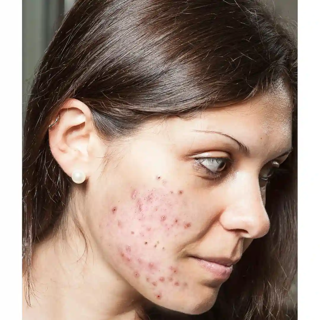 skin-care-treatments-in-kochi-acne-before