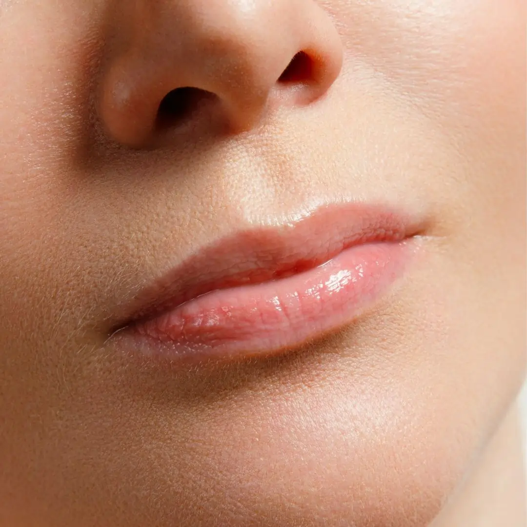 skin-care-treatments-in-kochi-lip-filler-before