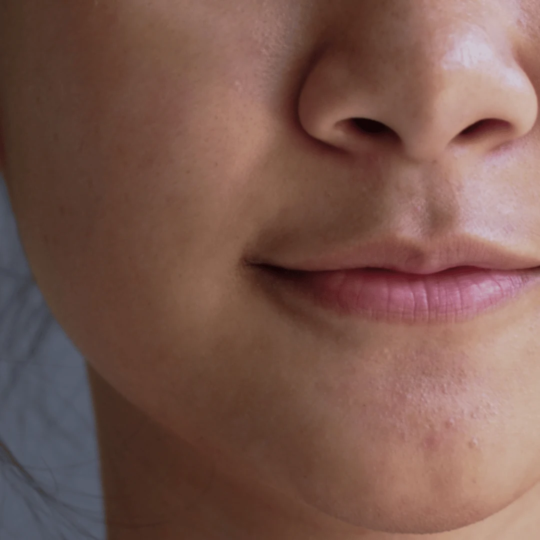 skin-care-treatments-in-kochi-lip-pigmentation