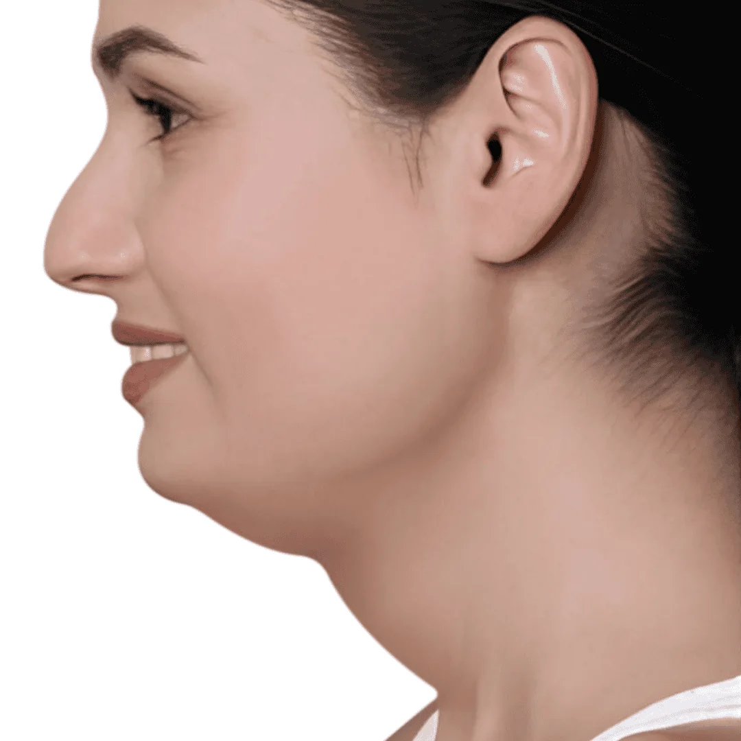 skin-treatment-center-in-kochi-doublechin