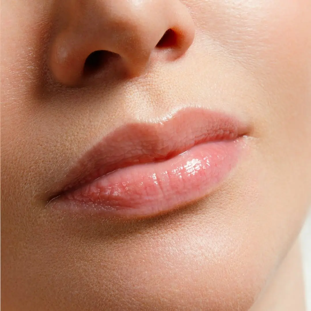 skin-treatment-center-in-kochi-lip-filler-after