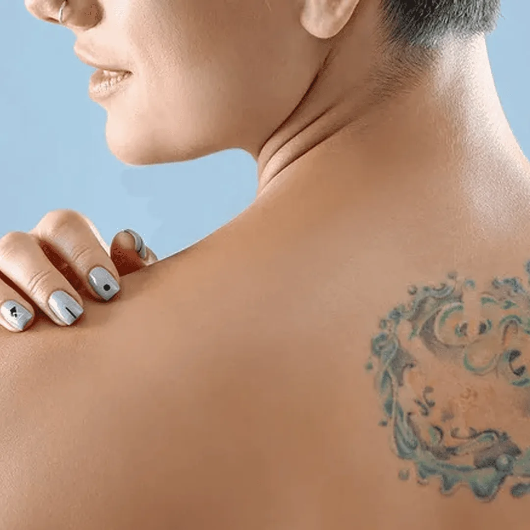 skin-treatment-center-in-kochi-tatto-before